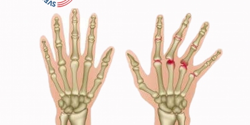 Kas yra reumatoidinis artritas?